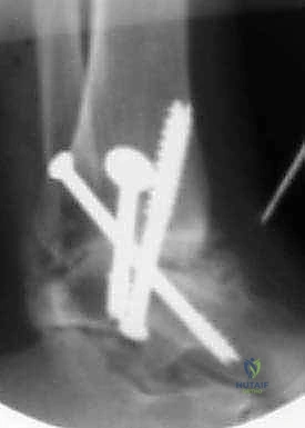 صورة توضيحية لـ دمج مفصل الكاحل عبر الشظية: حل جذري لالتهاب المفاصل المتقدم مع الأستاذ الدكتور محمد هطيف