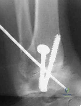 صورة طبية: دمج مفصل الكاحل عبر الشظية: حل جذري لالتهاب المفاصل المتقدم مع الأستاذ الدكتور محمد هطيف