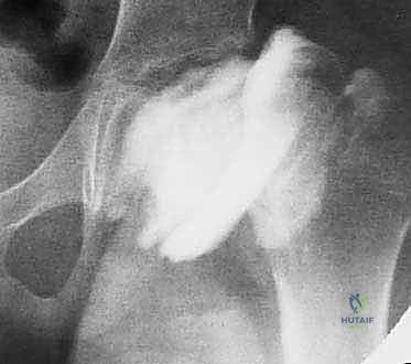 صورة توضيحية لـ قطع عظم الفخذ التقويمي (فالجوس) لعلاج مرض بيرثيس: استعادة حركة الورك وتخفيف الألم