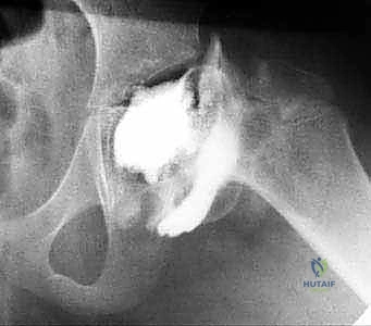 قطع عظم الفخذ التقويمي (فالجوس) لعلاج مرض بيرثيس: استعادة حركة الورك وتخفيف الألم