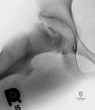 صور قبل وبعد العملية تظهر تحسن زوايا المفصل