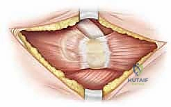 الأستاذ الدكتور محمد هطيف أثناء إجراء جراحة دقيقة