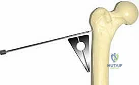التخطيط الهندسي لعملية قطع العظم التقويمي
