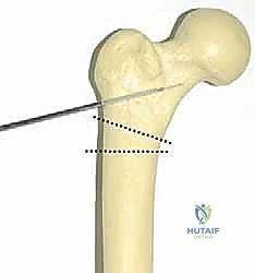 صورة توضح ظاهرة انحراف المفصل الوركي Hinge Abduction
