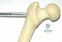 صور الأشعة السينية والتخطيط الجراحي لعملية فالجوس