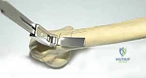 خطوات الوصول الجراحي الدقيق