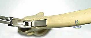 تثبيت العظم باستخدام الشرائح والمسامير الطبية المتقدمة