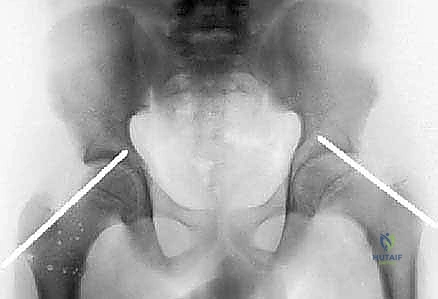 انزلاق رأس الفخذ الأعلى (SCFE): دليل شامل للعلاج والتعافي في صنعاء مع الأستاذ الدكتور محمد هطيف