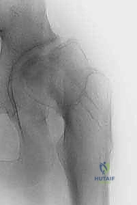 Percutaneous In Situ Cannulated Screw Fixation for Slipped Capital Femoral Epiphysis: An Intraoperative Masterclass