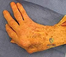 التشوهات الهيكلية المعقدة الناتجة عن التهاب مفاصل اليد