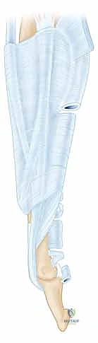 تأثير التهاب المفاصل التنكسي والخشونة على مفصل الأصابع