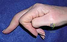 الشق الجراحي والوصول إلى مفصل اليد التالف