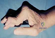 صورة توضيحية لـ جراحة استبدال سطح مفاصل اليد MCP و PIP