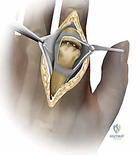 تحضير العظام وتوسيع القناة النخاعية لاستقبال المفصل الصناعي