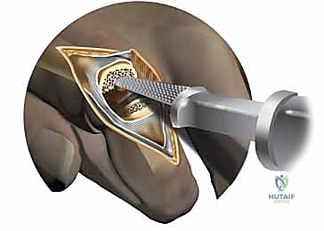 إدخال الغرسة الصناعية (المفصل الجديد) داخل العظام