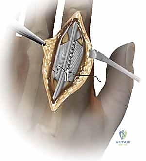 جراحة استبدال سطح مفاصل اليد MCP و PIP: استعادة الحركة وتخفيف الألم مع الأستاذ الدكتور محمد هطيف