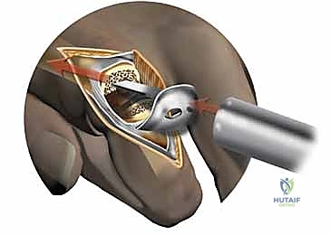 التخطيط الجراحي والتصوير الشعاعي لمفاصل اليد قبل العملية