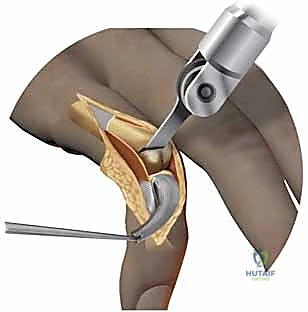 صورة توضيحية لـ جراحة استبدال سطح مفاصل اليد MCP و PIP: استعادة الحركة وتخفيف الألم مع الأستاذ الدكتور محمد هطيف