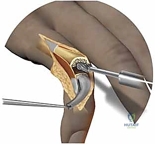 إغلاق الجرح بعد استبدال مفصل اليد بنجاح