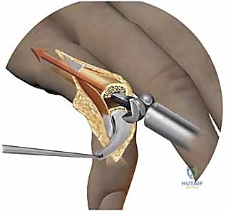 استخدام الجبائر الديناميكية في مرحلة التأهيل بعد الجراحة
