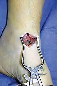 صورة توضيحية لـ تثبيت مفصل الكاحل بالشق الجراحي المصغر: دليل شامل لمرضى خشونة الكاحل