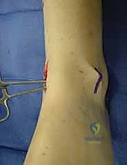 الأشعة السينية تظهر خشونة الكاحل