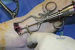 صورة توضيحية لـ تثبيت مفصل الكاحل بالشق الجراحي المصغر: دليل شامل لمرضى خشونة الكاحل