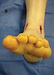 صورة توضيحية لـ تثبيت مفصل الكاحل بالشق الجراحي المصغر: دليل شامل لمرضى خشونة الكاحل