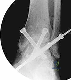 تآكل الغضاريف في مفصل الكاحل