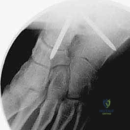 صورة توضيحية لـ تثبيت مفصل الكاحل بالشق الجراحي المصغر: دليل شامل لمرضى خشونة الكاحل