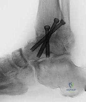 FIG 2  AP and lateral postoperative radiographs are evaluated to ensure the desired alignment of the arthrodesis and check the screw position