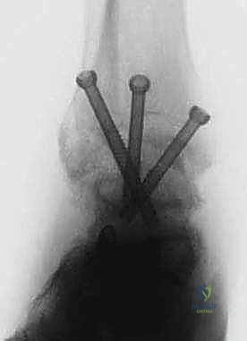 Miniarthrotomy Ankle Arthrodesis: A Masterclass in Surgical Technique and Intraoperative Excellence