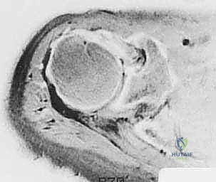 إصلاح تمزق الكفة المدورة المفتوح في الكتف: دليل شامل للمرضى مع الأستاذ الدكتور محمد هطيف في صنعاء