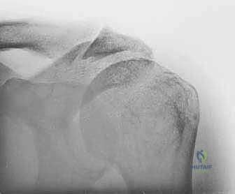 Mastering Open Rotator Cuff Repair: Acromioplasty, Distal Clavicle Excision, and Posterosuperior Tendon Reconstruction