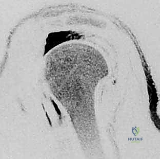 تأثير تمزق الكفة المدورة على حركة الذراع