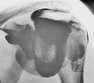 الفحص السريري الدقيق لمفصل الكتف مع الأستاذ الدكتور محمد هطيف