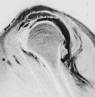 الأشعة السينية لتقييم المسافة تحت الأخرم