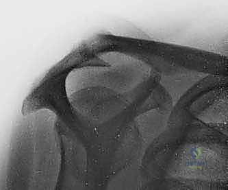 الخيارات العلاجية لتمزقات الكتف المعقدة