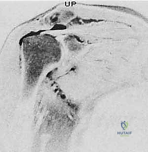 مقارنة بين الجراحة المفتوحة والمنظار