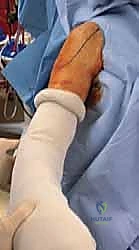 تجهيز المريض والتخدير قبل جراحة الكتف