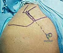 تفاصيل العضلات الأربع المكونة للكفة المدورة