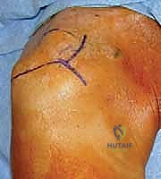 رأس عظم العضد وارتباطه بالأوتار