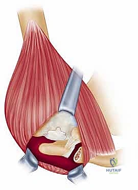 الإصابات الرياضية والمهنية وتأثيرها على الكتف