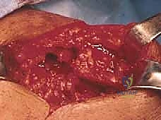 التمزق التنكسي في أوتار الكتف مع التقدم في العمر