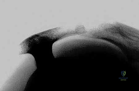 عملية تجميل الأخرم وإزالة النتوءات العظمية الضاغطة