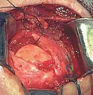 صورة توضيحية لـ إصلاح تمزق الكفة المدورة المفتوح في الكتف: دليل شامل للمرضى مع الأستاذ الدكتور محمد هطيف في صنعاء