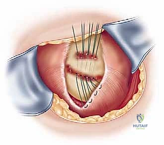 استخدام الخطاطيف الجراحية لتثبيت الوتر في العظم