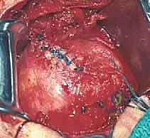 تحرير الأوتار المنسحبة والمتيبسة