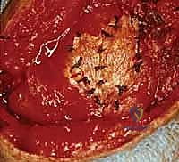 صورة توضيحية لـ إصلاح تمزق الكفة المدورة المفتوح في الكتف: دليل شامل للمرضى مع الأستاذ الدكتور محمد هطيف في صنعاء