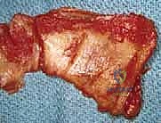 صورة توضيحية لـ إصلاح تمزق الكفة المدورة المفتوح في الكتف: دليل شامل للمرضى مع الأستاذ الدكتور محمد هطيف في صنعاء